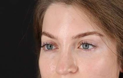 Browlift Before & After Patient #1319