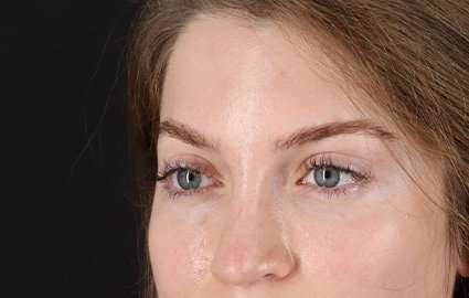 Browlift Before & After Patient #1319
