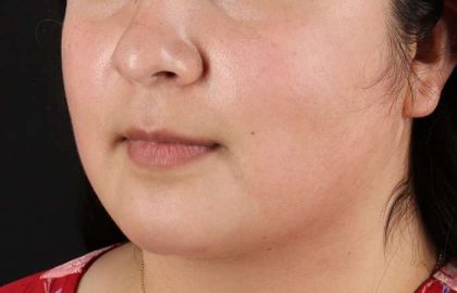 Neck Lift Before & After Patient #2549