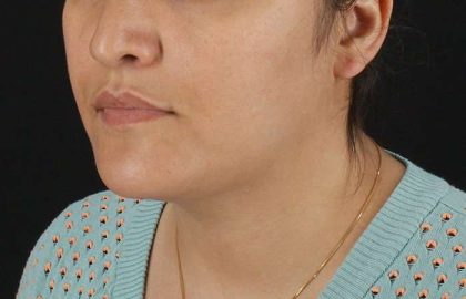 Neck Lift Before & After Patient #2560