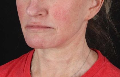 Neck Lift Before & After Patient #2571