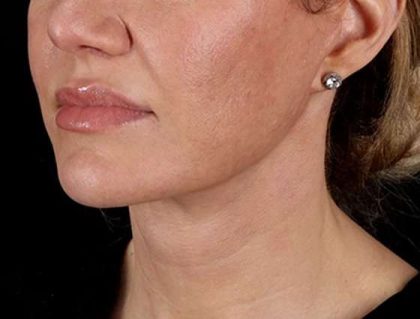 Neck Lift Before & After Patient #2626