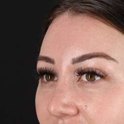 Browlift Before & After Patient #1330