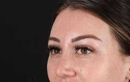 Browlift Before & After Patient #1330