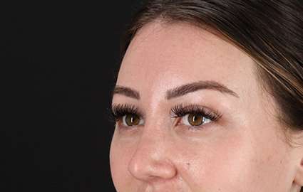 Browlift Before & After Patient #1330