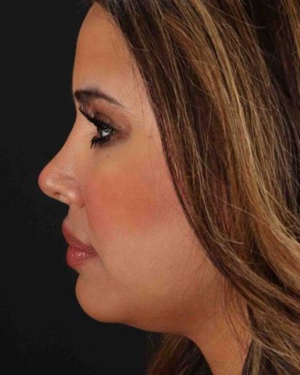 Neck Liposuction Before & After Patient #2708