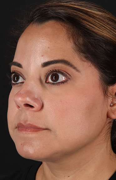 Neck Liposuction Before & After Patient #2752