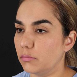 Browlift Before & After Patient #1341