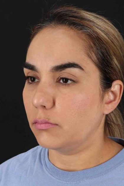 Browlift Before & After Patient #1341