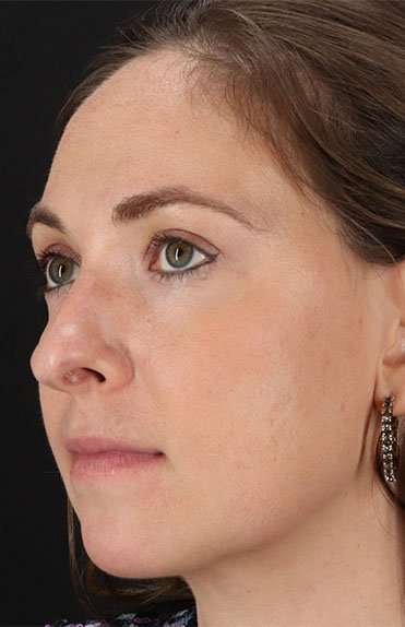 Neck Liposuction Before & After Patient #2785
