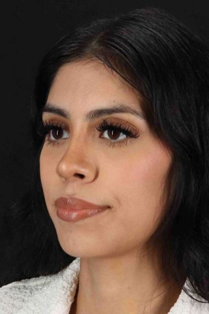 Rhinoplasty Before & After Patient #2818