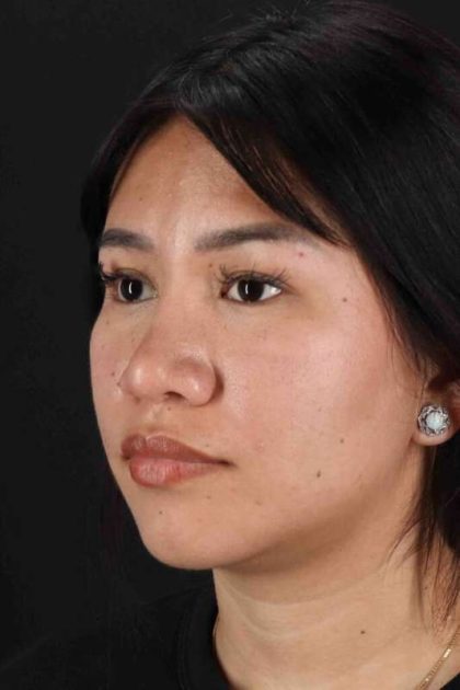 Rhinoplasty Before & After Patient #2829