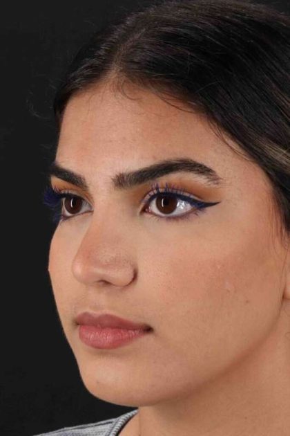 Rhinoplasty Before & After Patient #2862