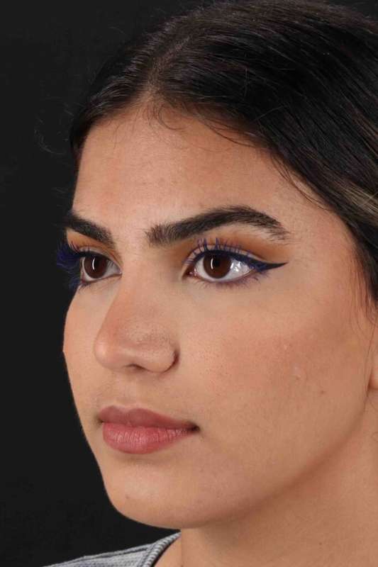 Rhinoplasty Before & After Patient #2862