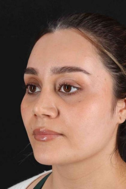 Rhinoplasty Before & After Patient #2873