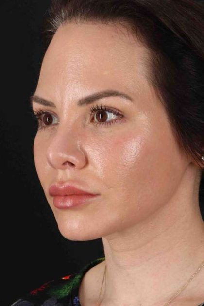 Rhinoplasty Before & After Patient #2884