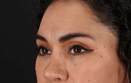Browlift Before & After Patient #1352