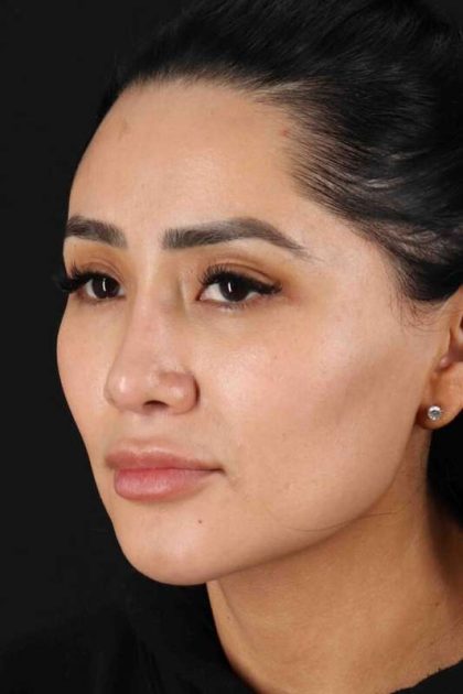 Rhinoplasty Before & After Patient #2895