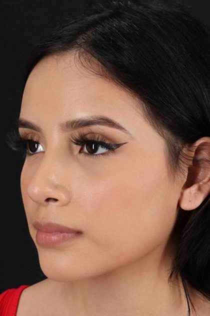 Rhinoplasty Before & After Patient #2917