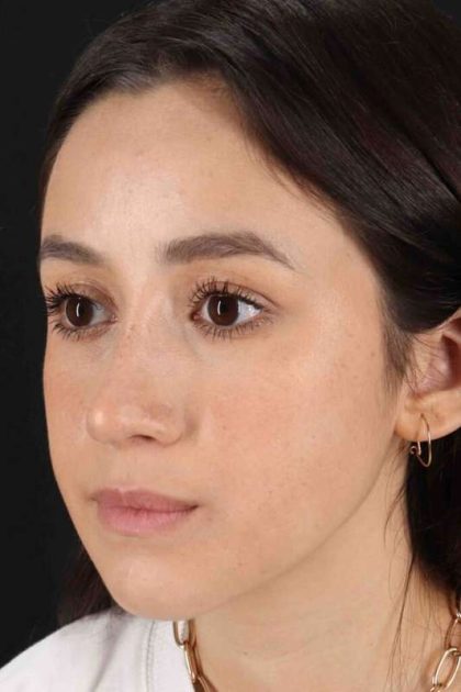 Rhinoplasty Before & After Patient #2928
