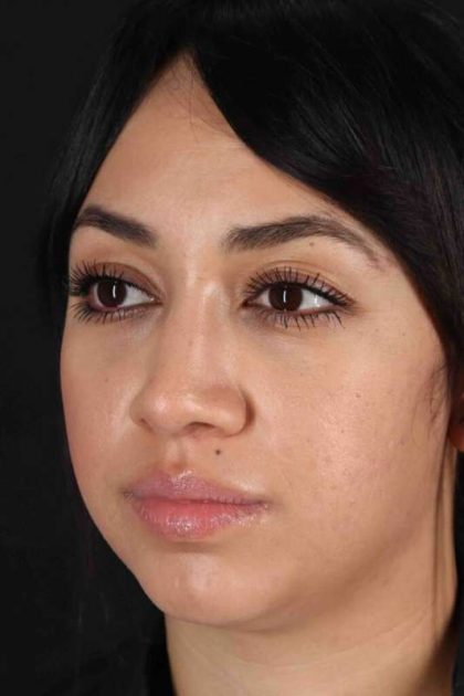 Rhinoplasty Before & After Patient #2939