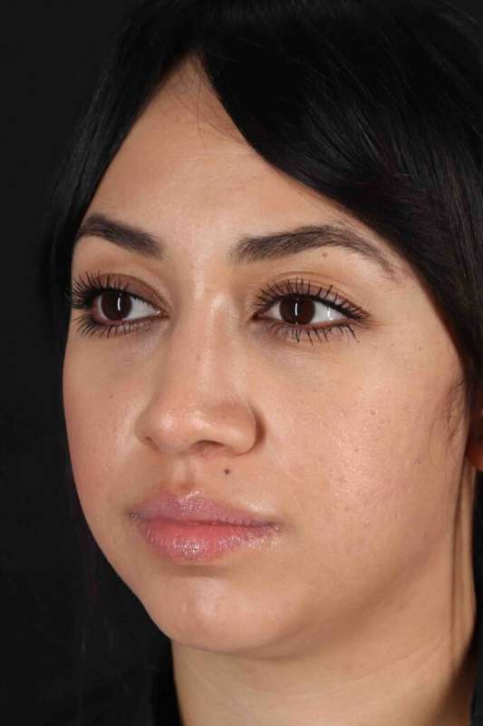 Rhinoplasty Before & After Patient #2939