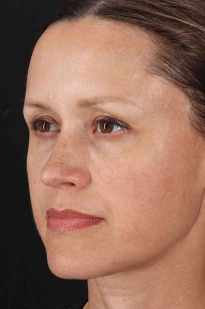 Rhinoplasty Before & After Patient #2950