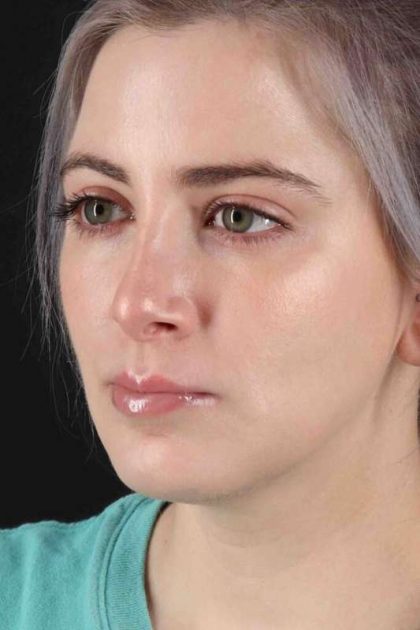 Rhinoplasty Before & After Patient #2961