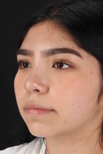 Rhinoplasty Before & After Patient #2972