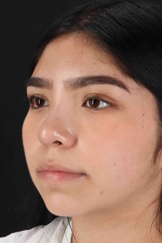 Rhinoplasty Before & After Patient #2972