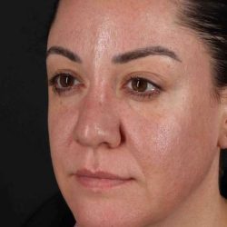 Browlift Before & After Patient #1363