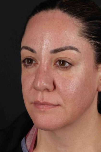 Browlift Before & After Patient #1363