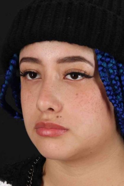 Rhinoplasty Before & After Patient #3016
