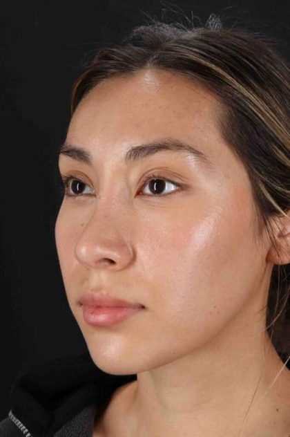 Rhinoplasty Before & After Patient #3027