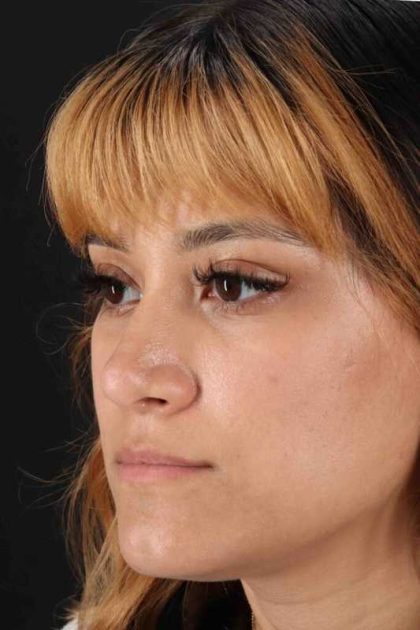 Rhinoplasty Before & After Patient #3038