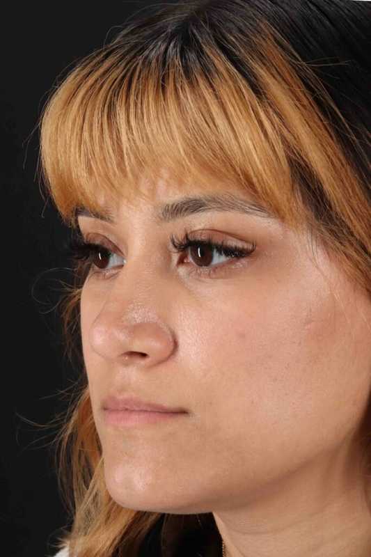 Rhinoplasty Before & After Patient #3038