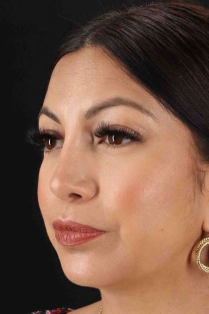 Rhinoplasty Before & After Patient #3049