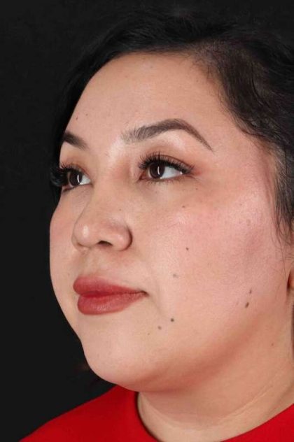 Rhinoplasty Before & After Patient #3060