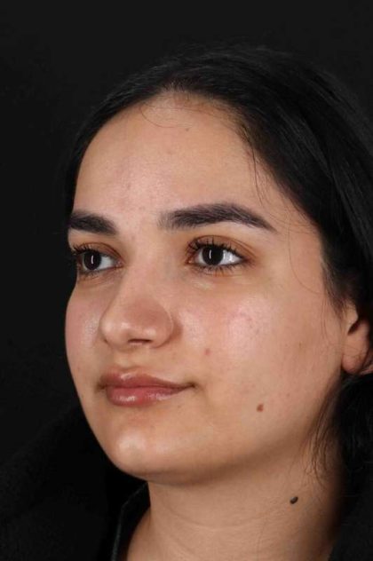 Rhinoplasty Before & After Patient #3071
