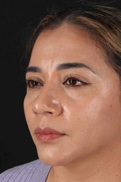 Rhinoplasty Before & After Patient #3082