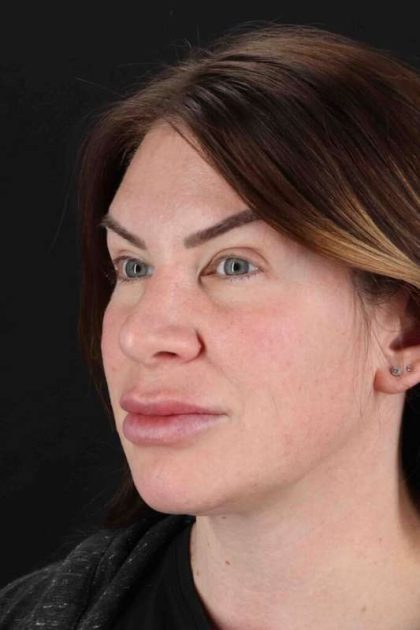 Rhinoplasty Before & After Patient #3093