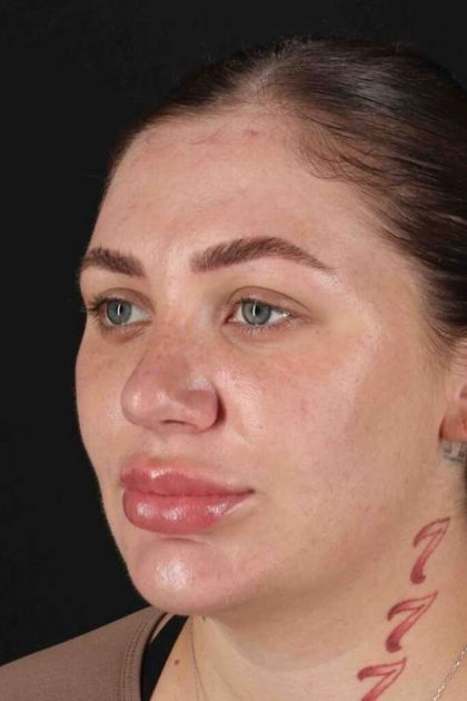 Rhinoplasty Before & After Patient #3104