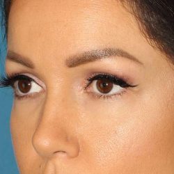 Browlift Before & After Patient #1384