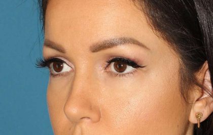 Browlift Before & After Patient #1384