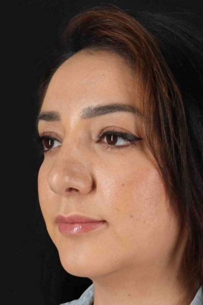 Rhinoplasty Before & After Patient #3115