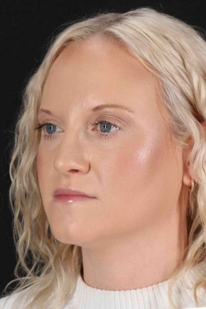 Rhinoplasty Before & After Patient #3126