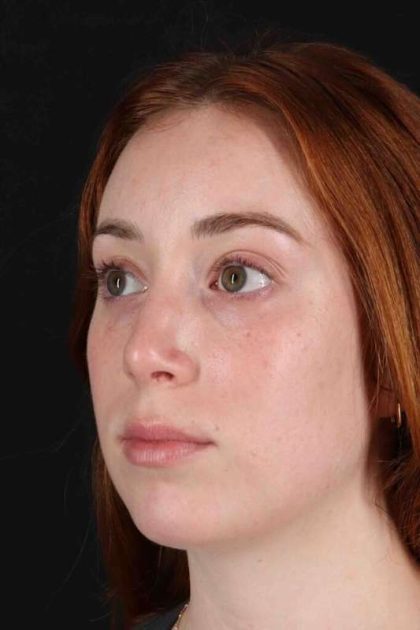 Rhinoplasty Before & After Patient #3170