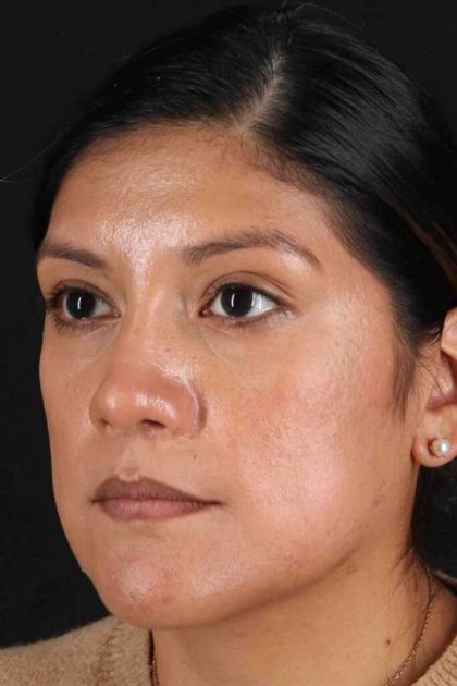 Rhinoplasty Before & After Patient #3181