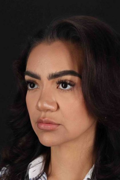 Rhinoplasty Before & After Patient #3192