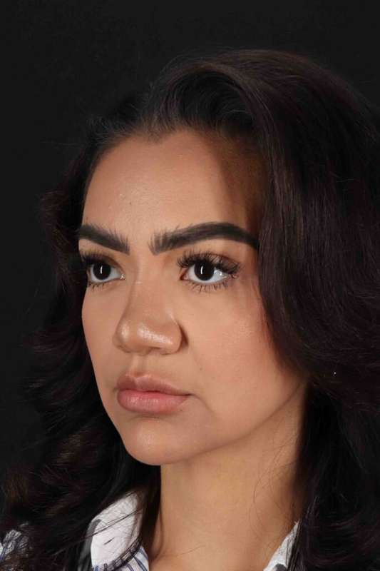 Rhinoplasty Before & After Patient #3192